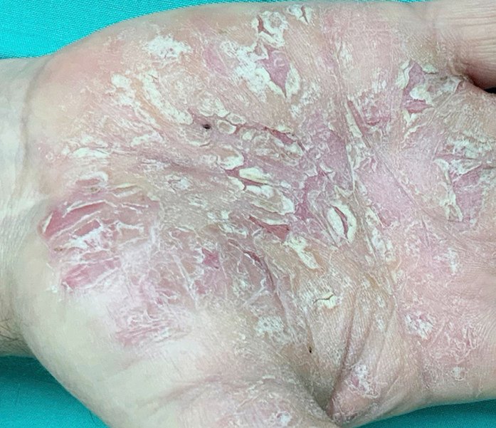 Abb. 3:  Psoriasis palmaris bei einem 58-jährigen Hausmeister. Es bestanden auch psoriatische Effloreszenzen an der Körperhaut, z. B. Ellenbogen, Knie, Capillitium (Foto: Prof. E. Weisshaar, Sektion Berufsdermatologie, Universitätsklinikum Heidelberg)